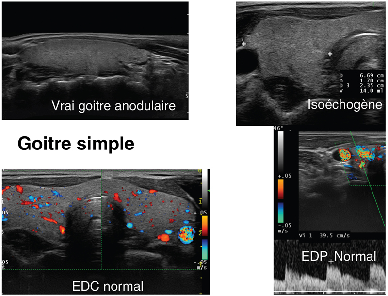 Échographie thyroïdienne et parathyroïdienne