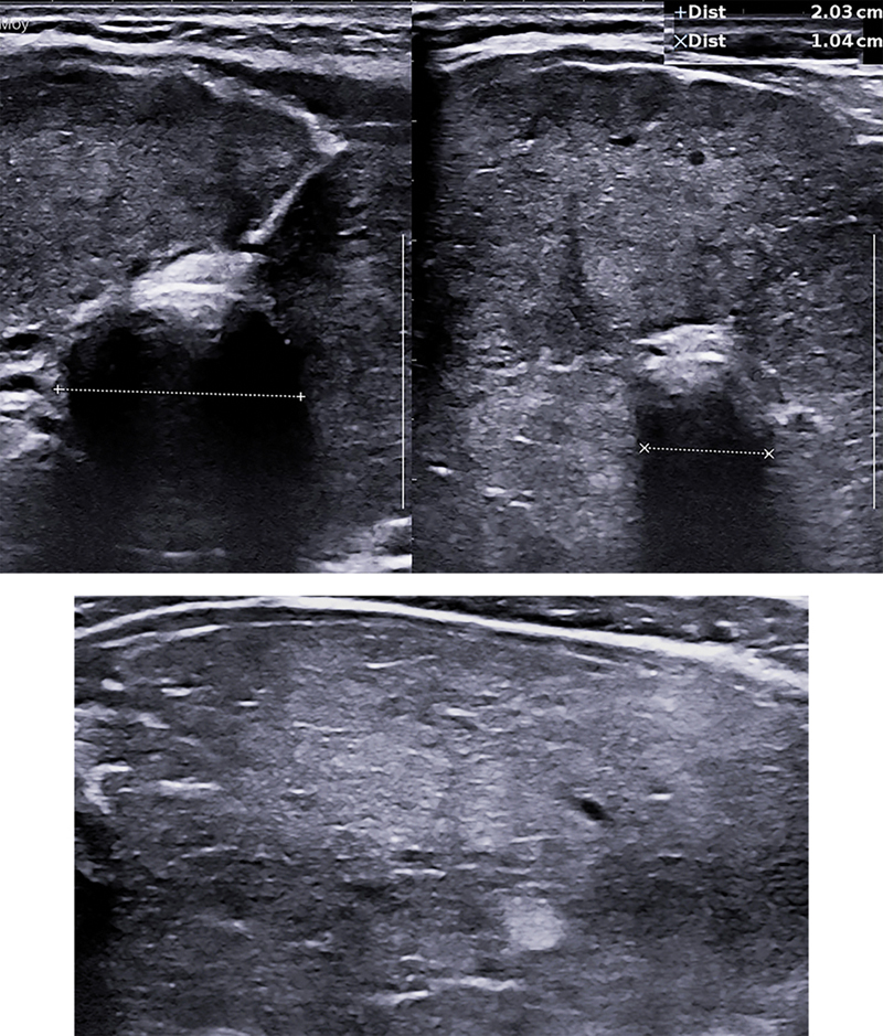 Échographie thyroïdienne et parathyroïdienne